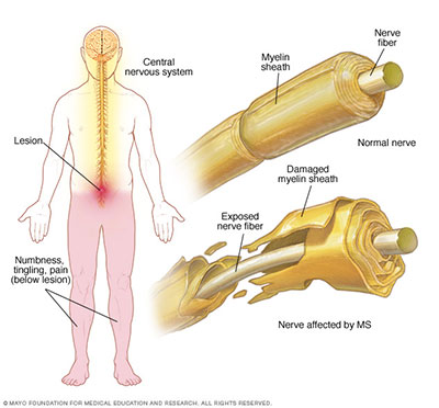 nervous system multiple sclerosis